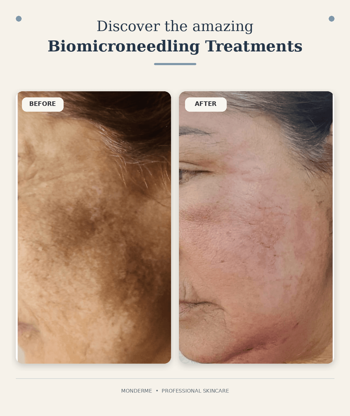 Biomicroneedling promotional graphic with side-by-side before-and-after cheek photos and the headline “Discover the amazing Biomicroneedling Treatments.”